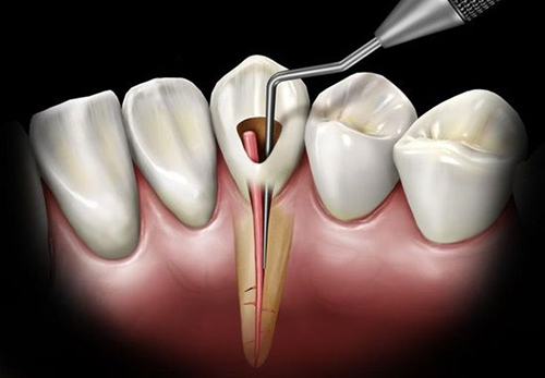درمان ریشه دندان چه قدر طول می‌کشد؟